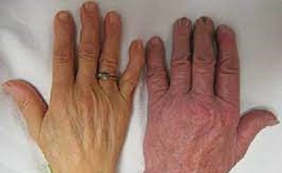 Pernicous Anemia